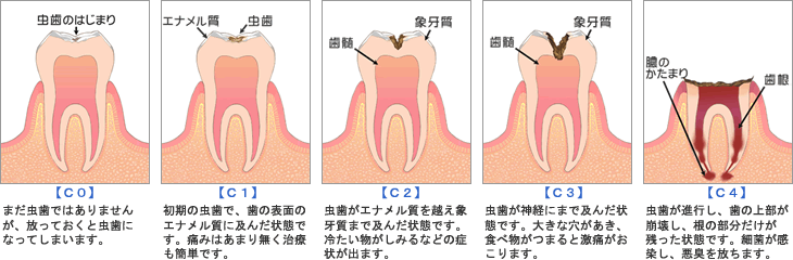 虫歯の進行具合